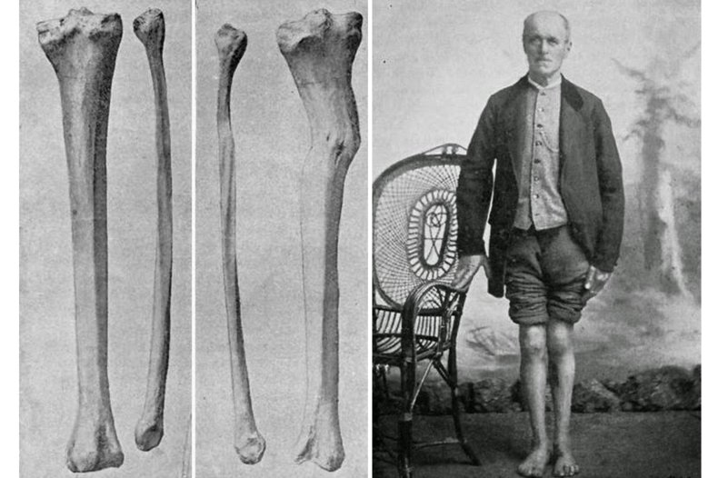 Pierre de Rudder, tibia et péroné. / © Public domain, via Wikimedia Commons.